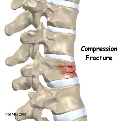 Spinal Compression Fractures