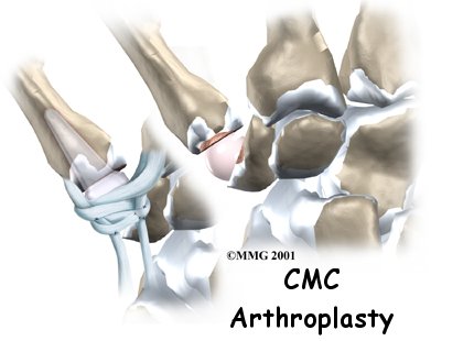 Artificial Joint Replacement of the Thumb - Physio Max's Guide