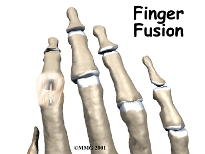 Finger Fusion Surgery - Physio Max's Guide